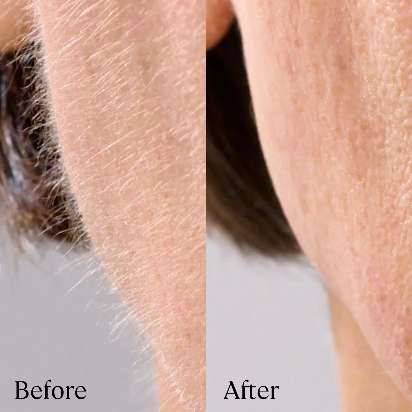 Sonicsmooth Pro+: Ultimate At-Home Dermaplaning Tool for Radiant Skin