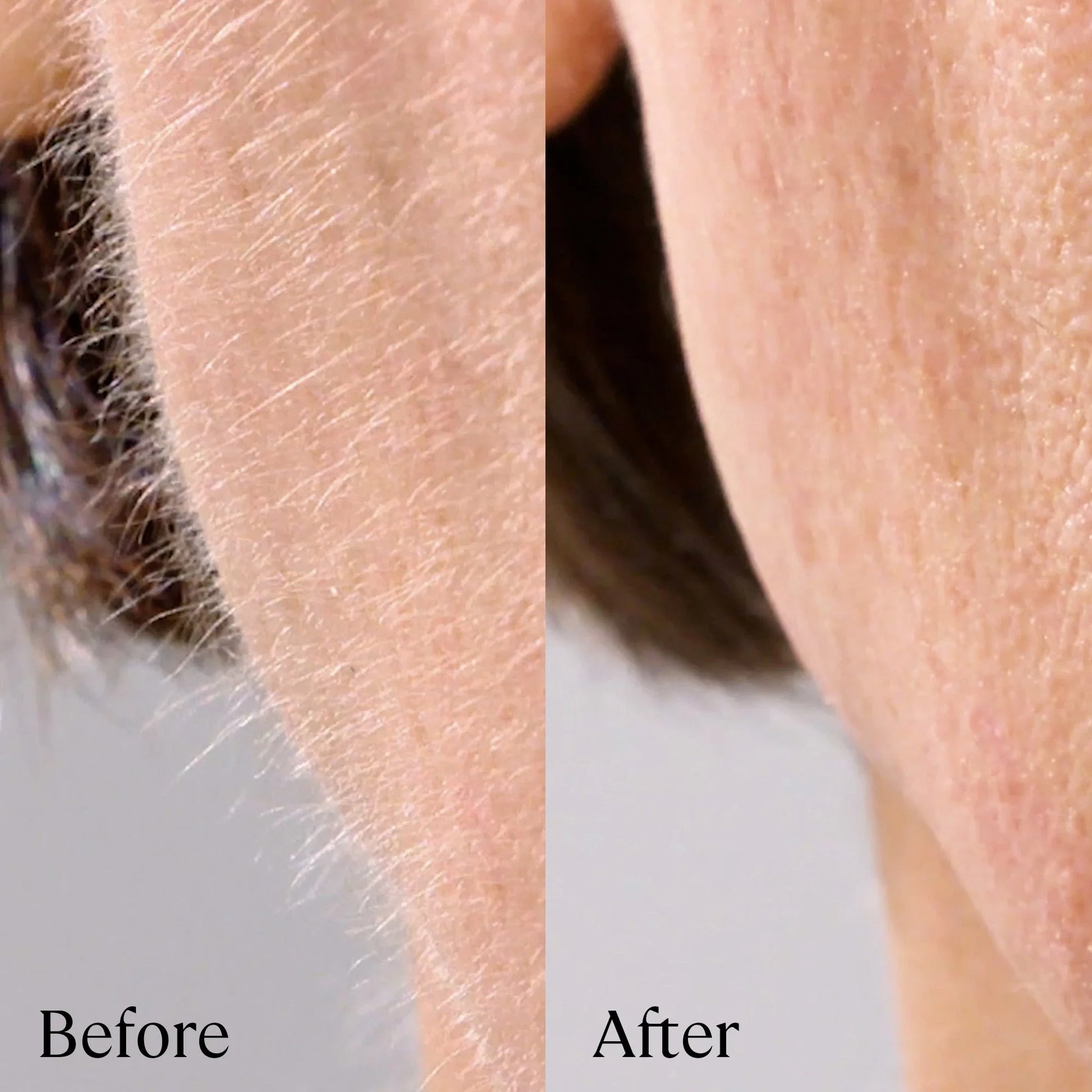Sonicsmooth Pro+: Ultimate At-Home Dermaplaning Tool for Radiant Skin